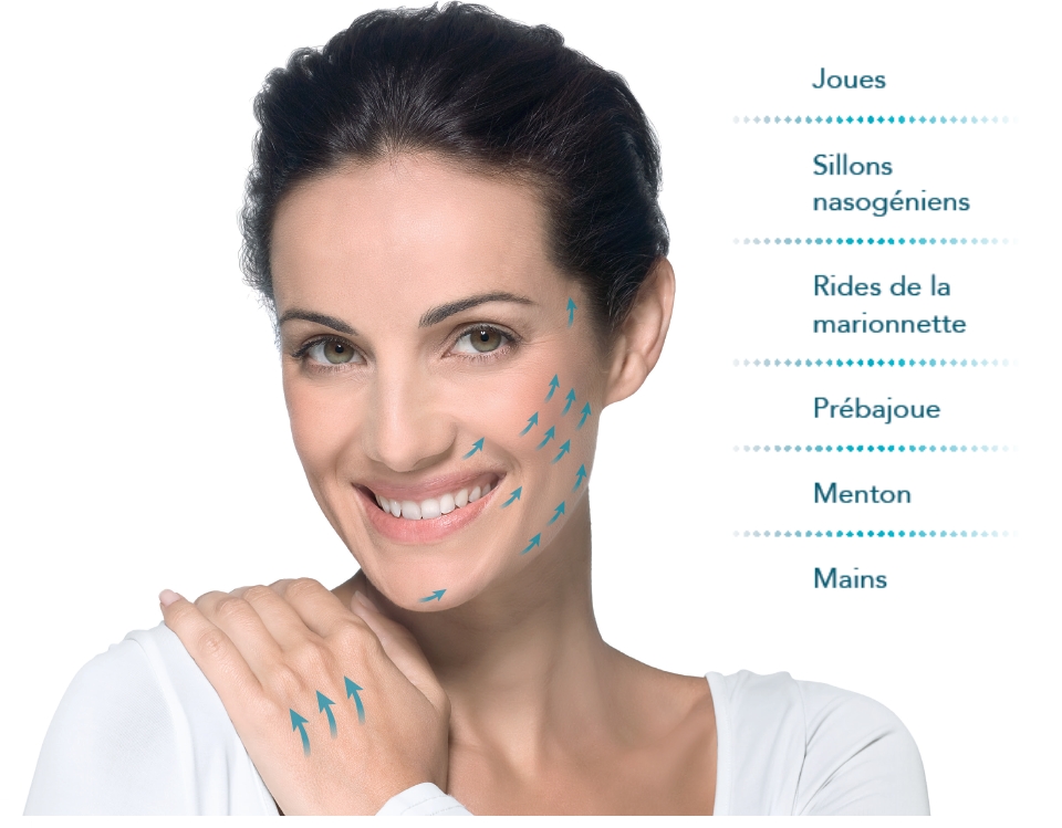 OM Signature - Injection Radiesse -  Clinique Esthétique Médicale Rive-Sud